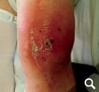 Kniegelenkinfektion nach Endoprothese